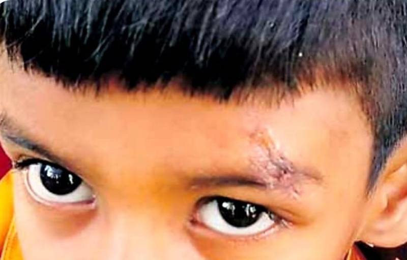 نرس کی بھیانک غلطی،بچے کے زخموں کو ٹانکوں کی بجائے ایلفی لگا دی