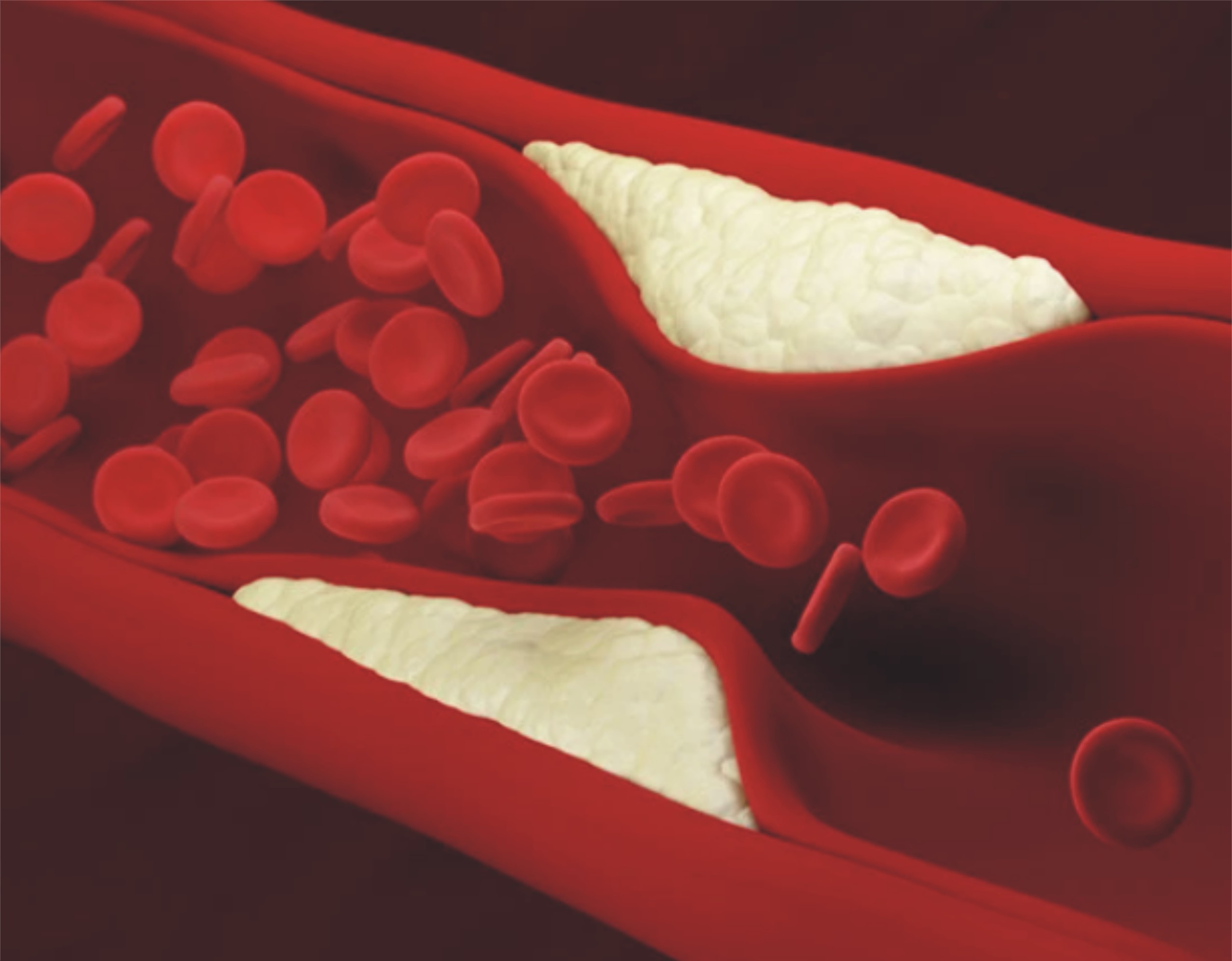 شریانوں میں جمی چکنائی کو کیسے دور کیا جائے؟