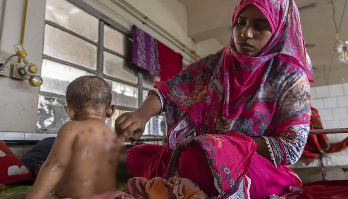 بنگلا دیش: خسرہ کے مشتبہ پھیلاؤ سے 98 بچے ہلاک، ویکسینیشن مہم تیز
