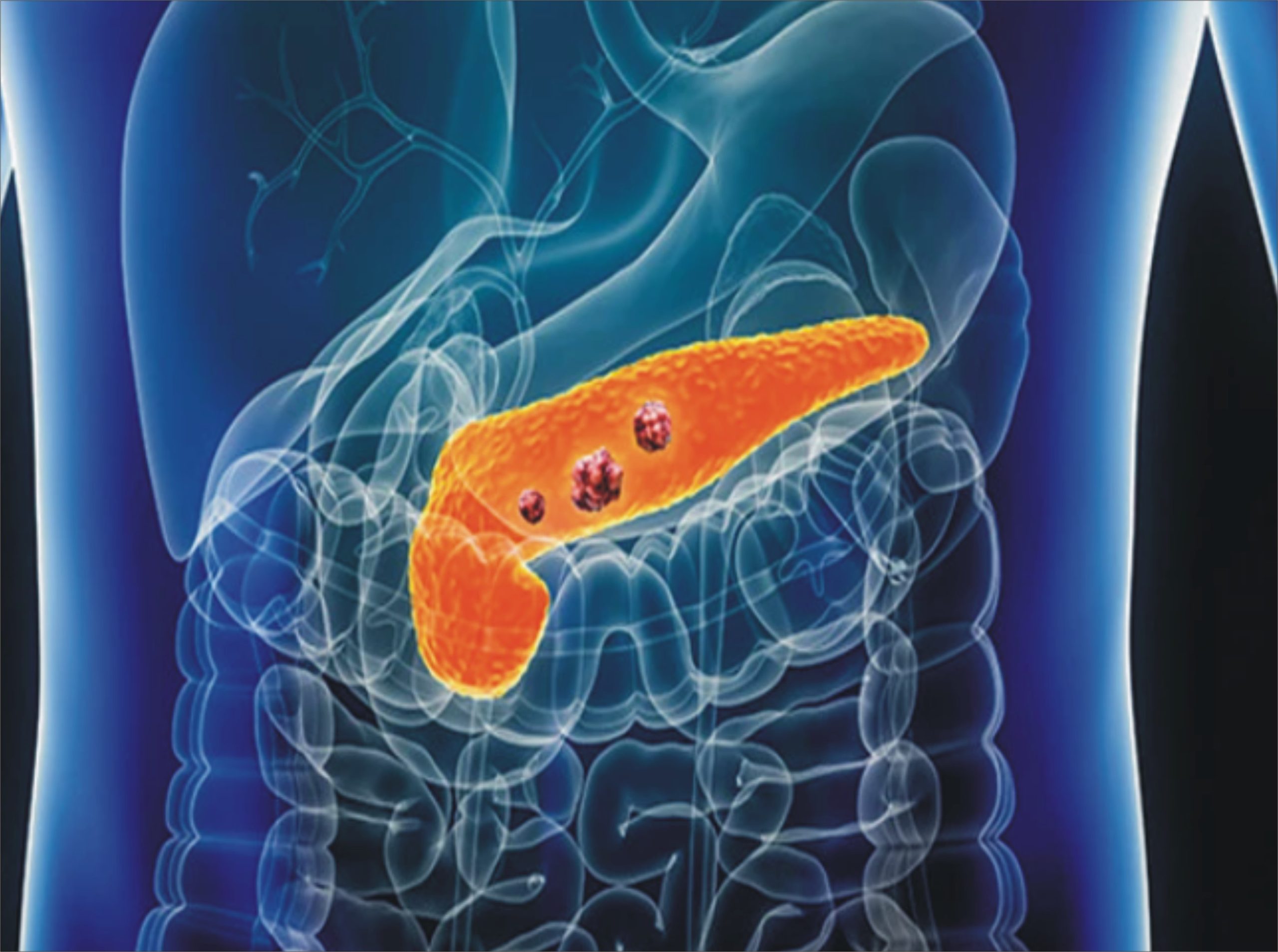 لبلبے کے کینسر کی نئی دوا میں اہم پیشرفت!