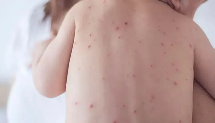 رواں سال سندھ میں خسرہ سے 53 اموات رپورٹ، ذرائع محکمہ صحت