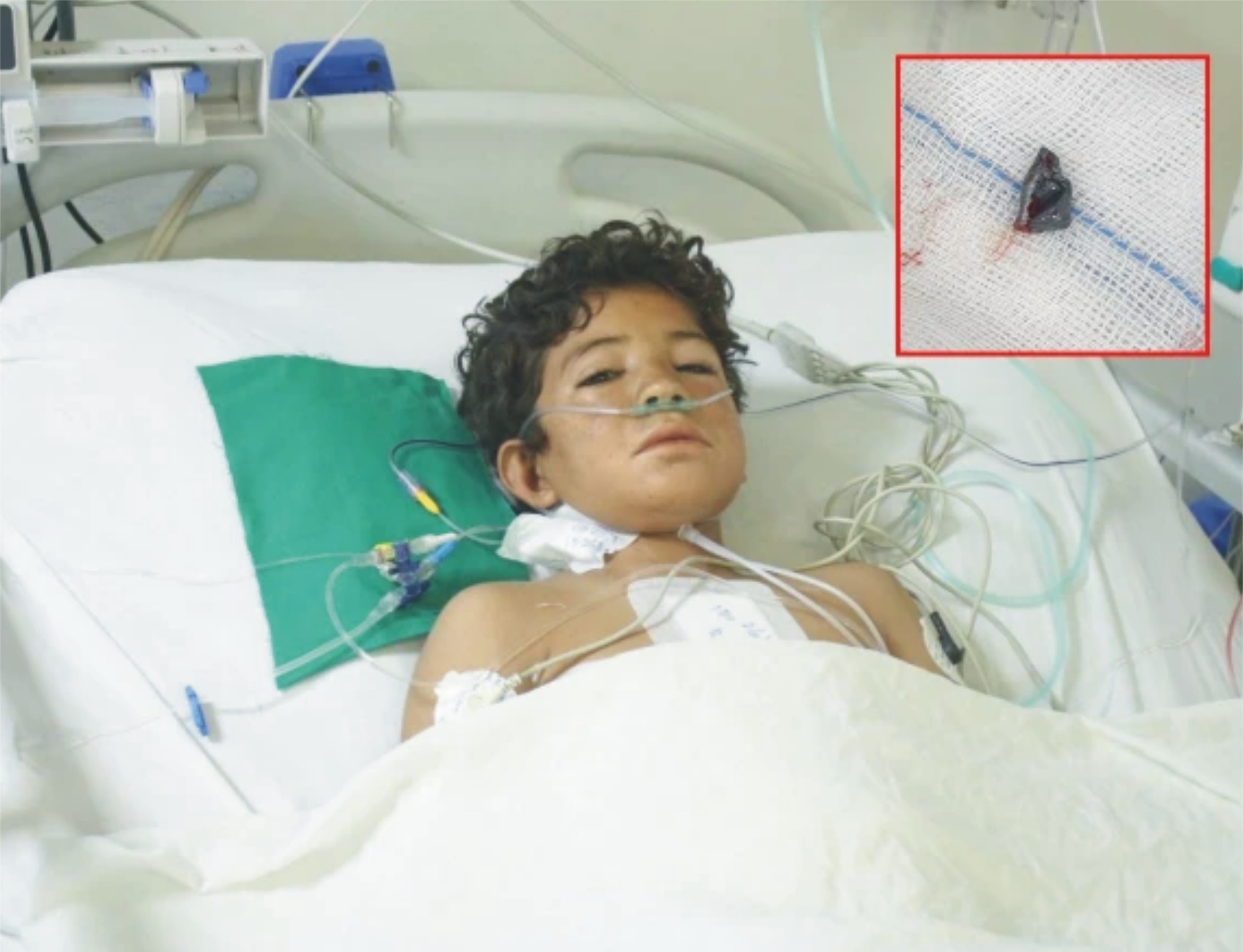 این آئی سی وی ڈی کراچی نے دل میں پیوست گولی نکال کر 12 سالہ بچے کی جان بچالی